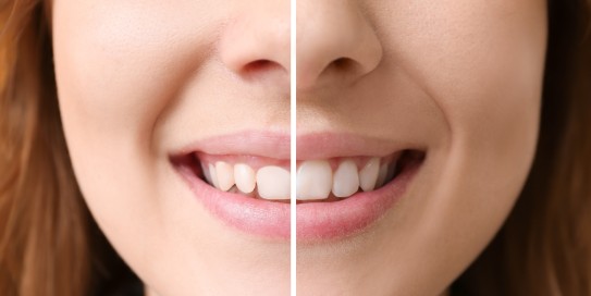 Nahansicht eines Lächelns mit vorher-nacher-Vergleich