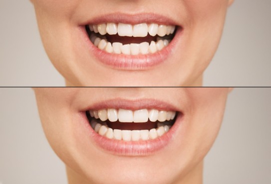 voher-nacher-Vergleich von schiefen zu geraden Zähnen